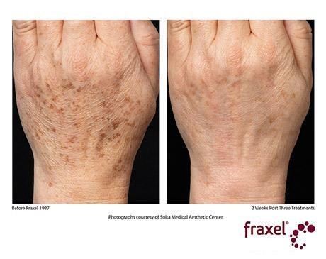 Fraxel Dual Before & After photo