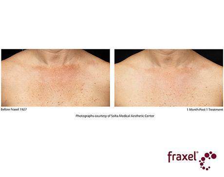 Fraxel Dual Before & After photo