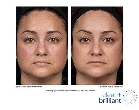 Clear + Brilliant Before & After Image of woman