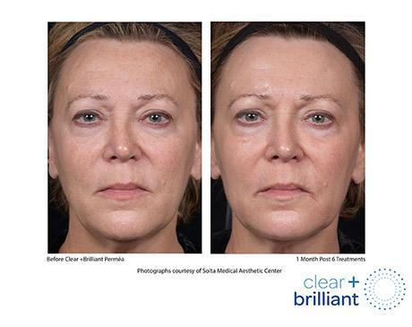 Clear + Brilliant Before & After Image of woman