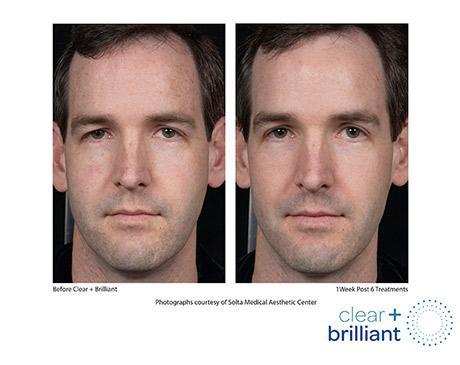 Clear + Brilliant Before & After Image of man
