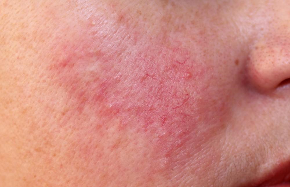Help! My Skin Is Always Red — What Could It Be?