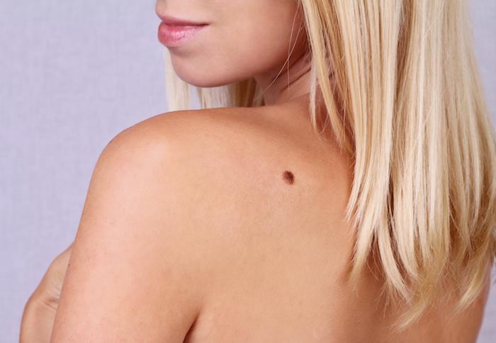 4 Reasons to Schedule a Skin Cancer Screening Every Year