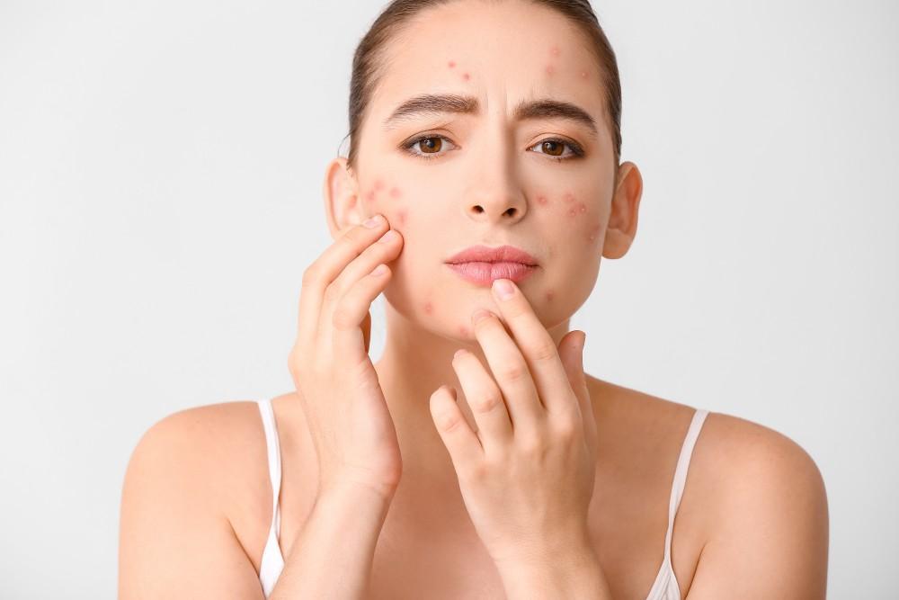 How to Ease Your Acne and Prevent More Flare-ups