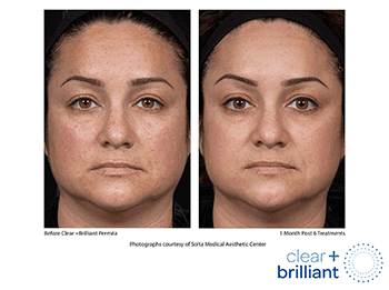 Clear+Brilliant Before & After photo of woman