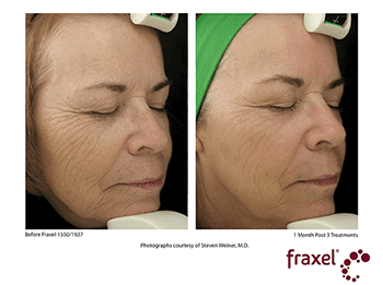 Fraxel Dual Before & After photo of woman